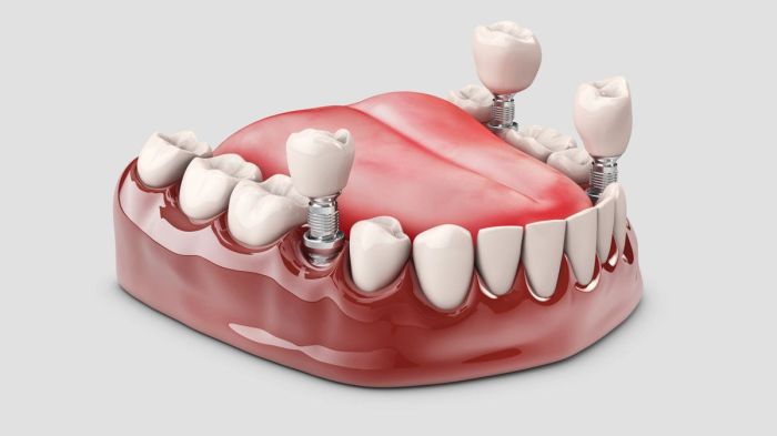 Harga pasang gigi palsu 1 biji permanen di puskesmas